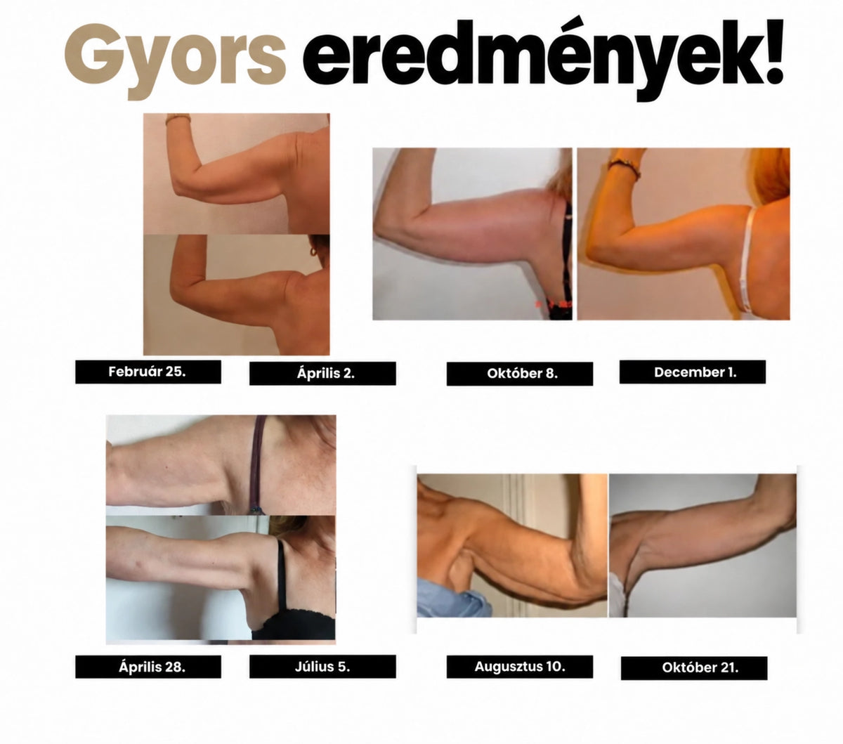 Nordlys™ 3D Shape Arm